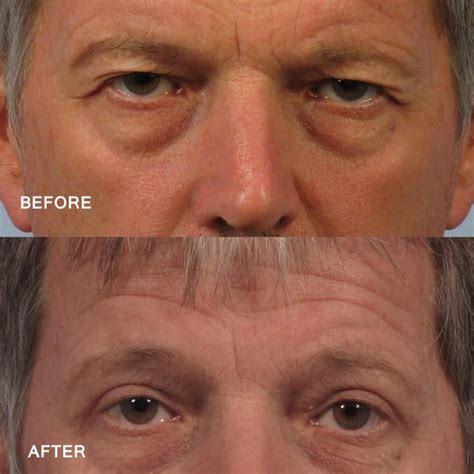 Upper Blepharoplasty Dr Brett Kotlus Cosmetic Oculoplastic Surgeon Nyc