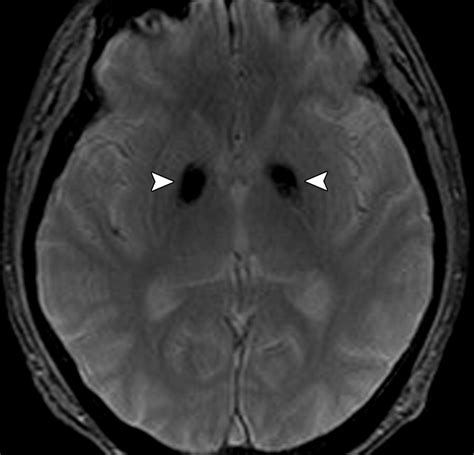 Differential Diagnosis For Bilateral Abnormalities Of The Basal Ganglia