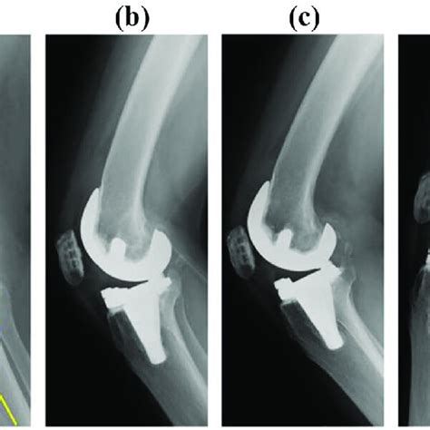 Post Operative Anteroposterior And Lateral Plain Radiographs The γ
