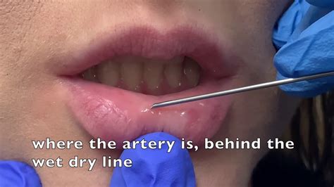 Lip Filler Injection Youtube