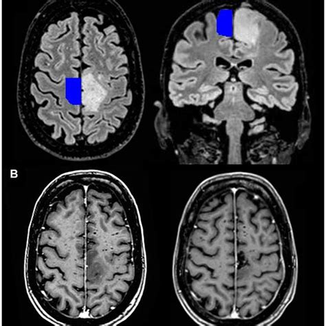 Proposed Mechanisms Of Modulation Of The Sma In Normal Subjects Sma