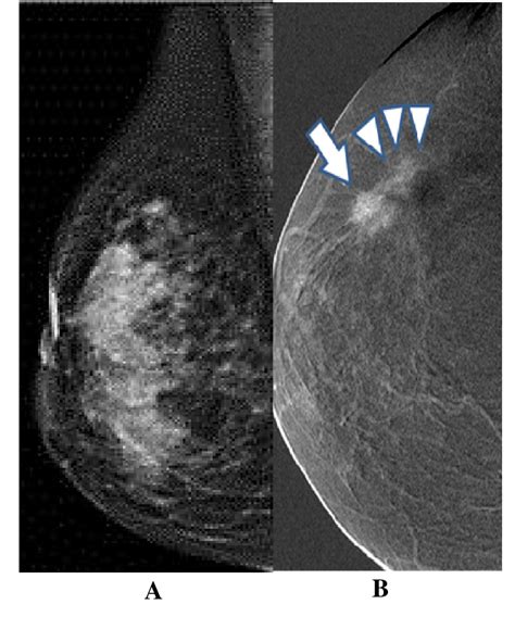 Invasive Ductal Carcinoma Mammogram
