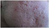 Images of Ice Pick Acne Scars