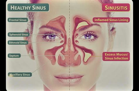 Sinusitis Atlantic Ear Nose And Throat