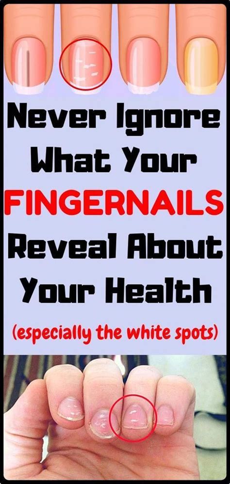 This Is What Your Fingernails Say About Your Health In 2020 With