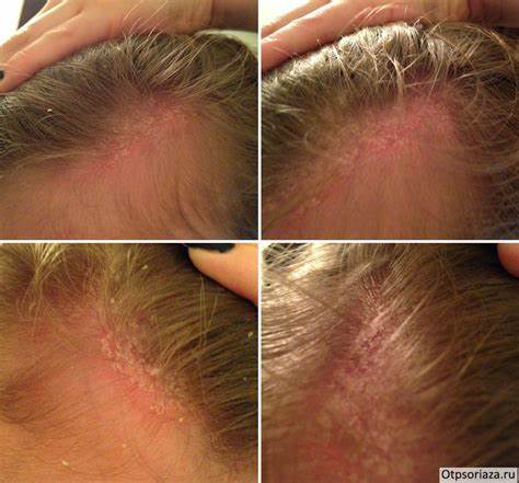 Псориаз диета по Как лечить псориаз на голове в домашних условиях Как лечить псориаз на голове в домашних условиях Псориаз диета по