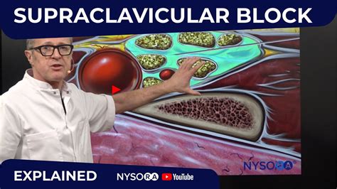 Supraclavicular Block Regional Anesthesia Crash Course With Dr