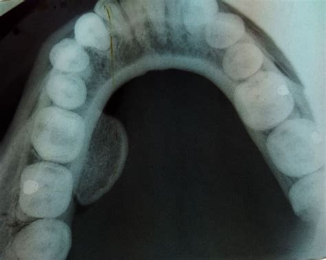 Peripheral Osteoma Of The Mandible Bmj Case Reports