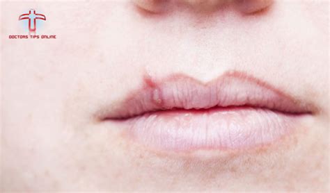 White Bumps Under Skin On Lips