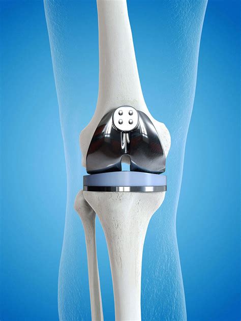 DePuy Knee Replacement Early Failure | Arentz Law Group, P.C.