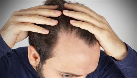 How To Get Rid Of Baldness DaileyNow