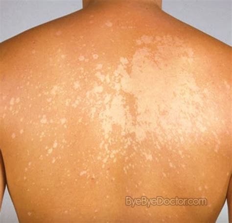 White Spots On Skin Pictures Causes And Treatment Minhhai2d Help