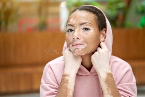 Black African American Woman With Vitiligo Pigmentation Skin Problem