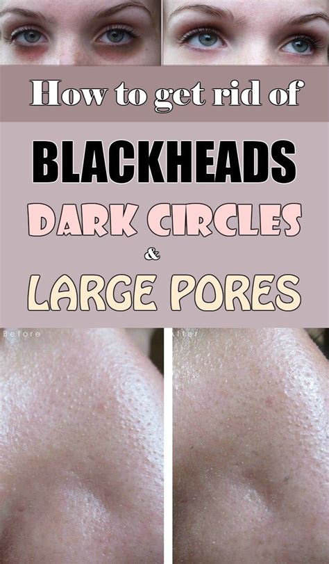 How To Get Rid Of Blackheads On Private Area Howtoremvo