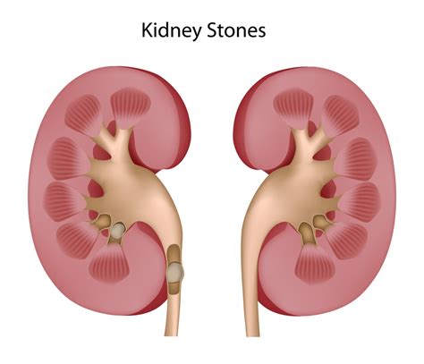 Kidney Stones Staffordshire Urology Clinic