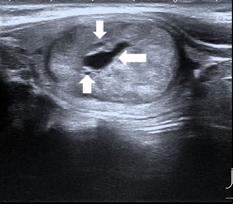 Ultrasonographic Characteristics Of Medullary Thyroid Carcinoma A