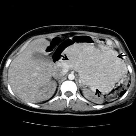 Abdominal Computed Tomography Scan Showing The Pancreatic Tumor