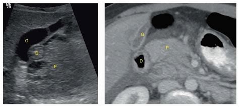 Pancreas Spleen And Bowel Radiology Key