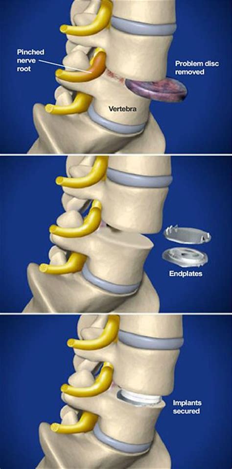 Pin On Surgical Procedures At Southeastern Spine