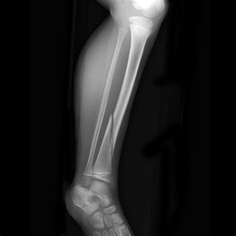 Spiral Fracture Fibula Saaduni