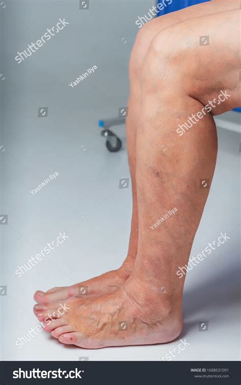 Varicose Veins Elderly Woman Inflamed Dilated Stock Photo 1688631091