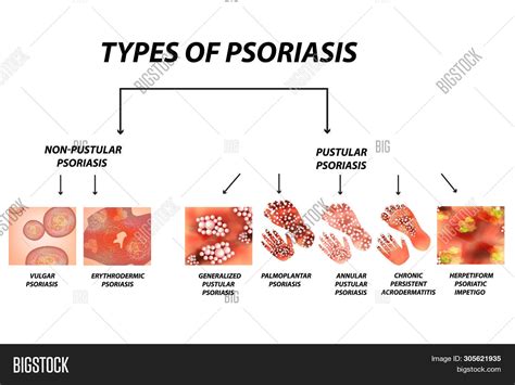 Psoriasis Types Chart