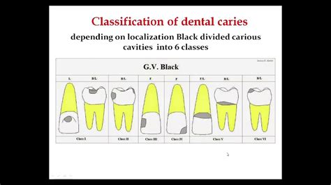 Classification Of Dental Caries Classes Of Caries Youtube