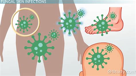 Skin Fungal Infections Types Causes And Symptoms Lesson