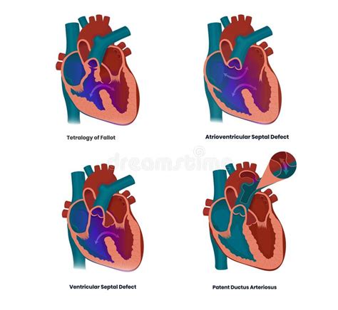 Heart Defects Causing Eisenmenger Syndrome Stock Vector Illustration