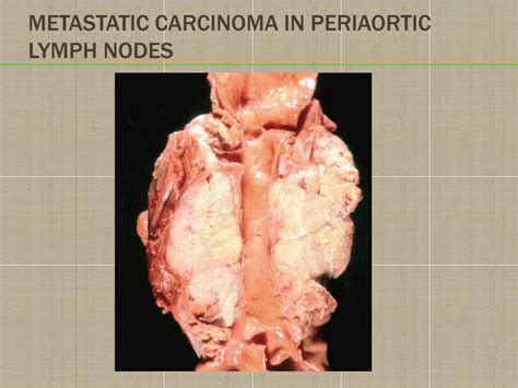 Ppt Chapter 7 Neoplasia Powerpoint Presentation Free Download Id