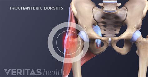 Hip Trochanteric Bursitis