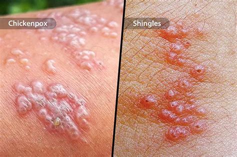 Skin Problems Blisters Causes And Treatment