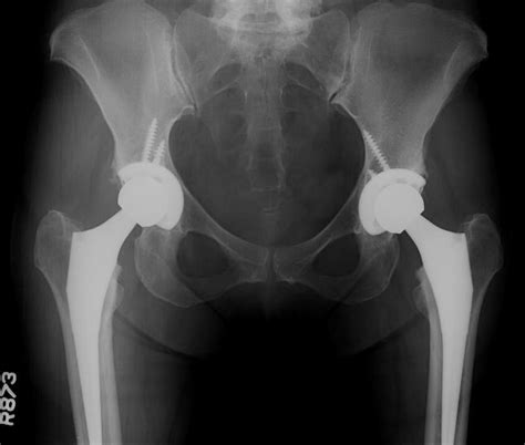 Total Hip Replacement In A Middle Aged Female Patient With Bilateral Hip Osteoarthritis St