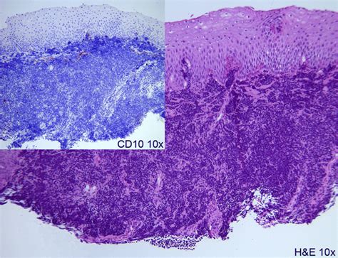 Endoscopic Esophageal Mucosal Biopsies Showing A Diffuse Dense