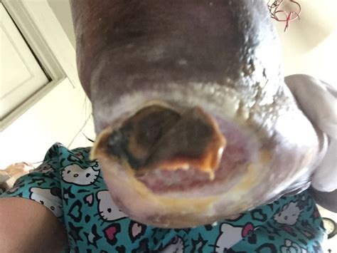 Wound care can be divided into. ENLUXTRA for Any Wound BLOG - ENLUXTRA