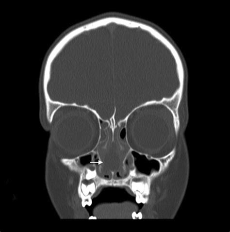 Spontaneous Nasal Septal Abscess Presenting As A Soft Tissue Mass In A