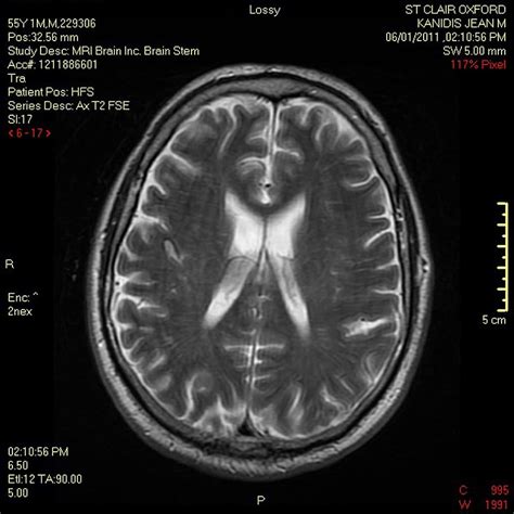 Brain Scan Mri Demyelinating Medical Doctors Magnetic Resonance