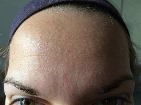 Small Flesh Colored Bumps On Forehead And Hairline Adult Acne Forum