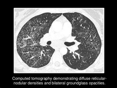 Asbestosis High Resolution Ct