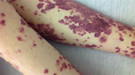 Purple Bumps On Skin Pictures Photos
