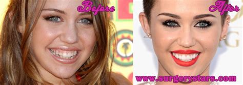 Miley Cyrus Teeth Before And After Pictures