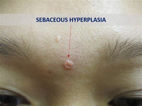 Natural Sebaceous Hyperplasia Treatment At Home