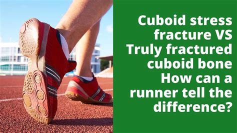 Cuboid Stress Fracture Vs Truly Fractured Cuboid Bone How Can A Runner