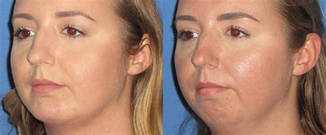 How Much Does Cheek Augmentation Cost