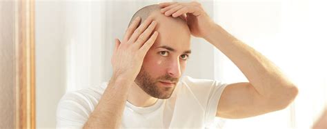 Details More Than 79 Hair Transplant Recovery In Eteachers