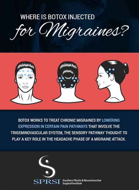 How Botox Can Help Improve Your Migraines SPRSI Blog