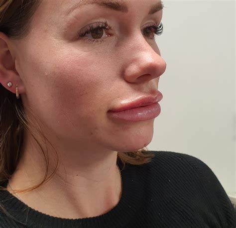 Lip Flip With Botox At Cavendish Aesthetics