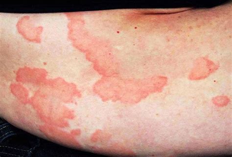 Picture Of Skin Diseases And Problems Urticaria