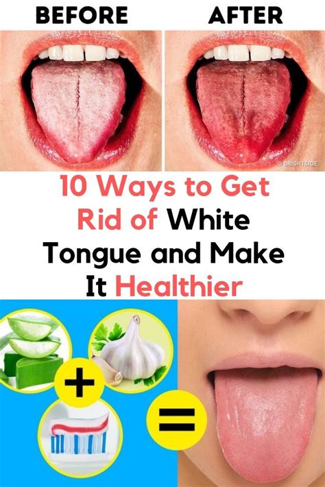 10 Ways To Get Rid Of White Tongue And Make It Healthier White Tongue