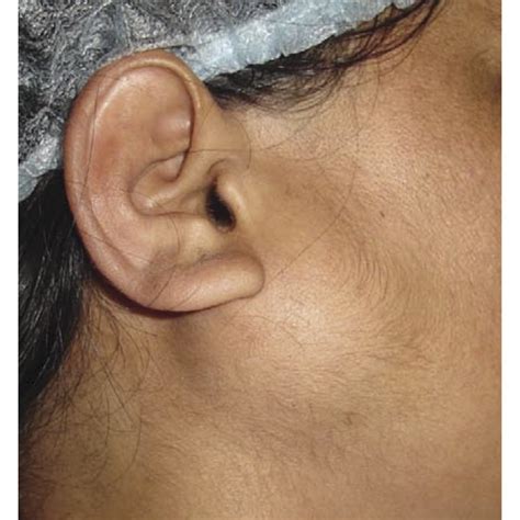 Pdf The Rare Cases Of Parotid Gland Arteriovenous Malformations